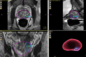 New diagnostic tool for prostate cancer